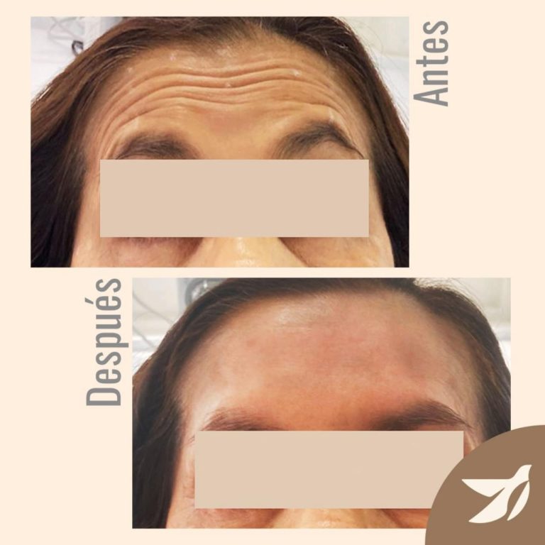 3.toxina botulinica (botox)